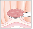 大腸カメラ